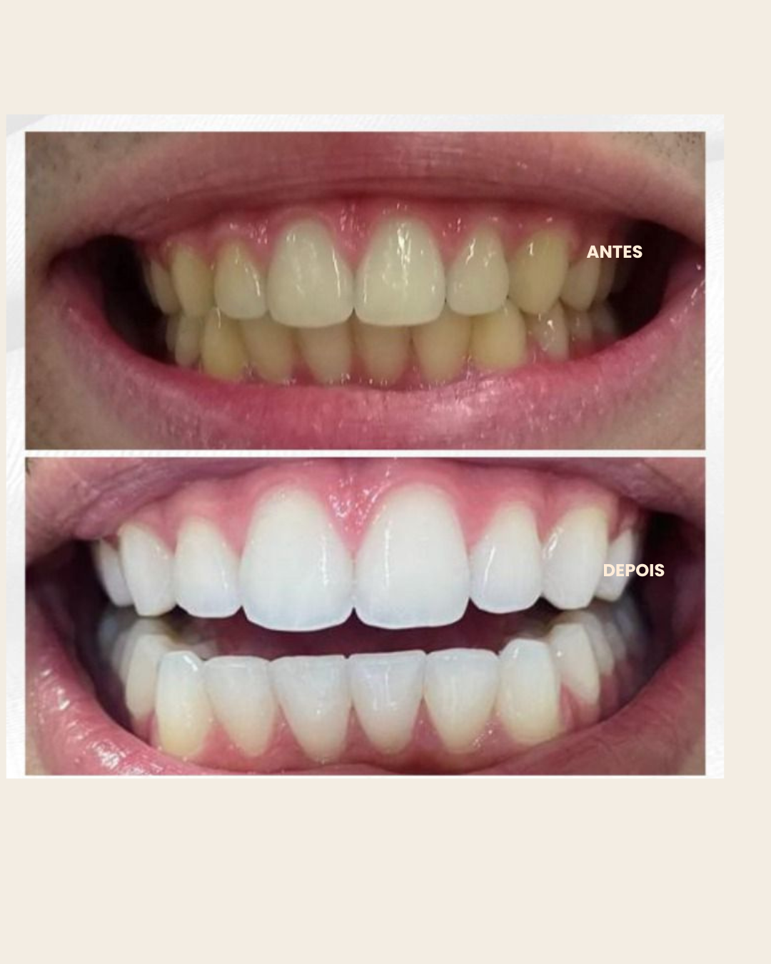 Caso clínico 1: fotografias de antes e depois do clareamento dental