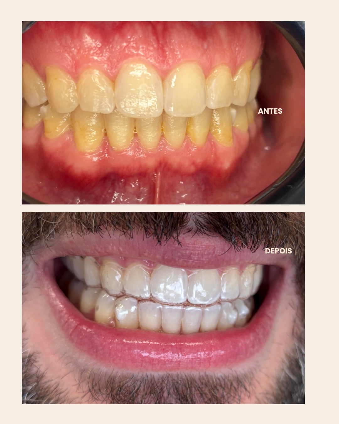 Caso clínico 2: fotografias de antes e depois do clareamento dental