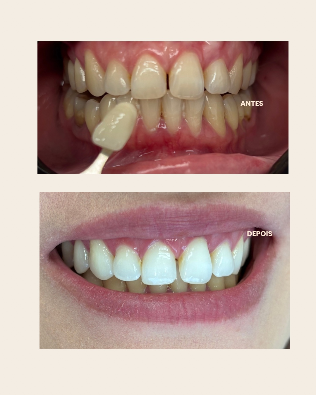 Caso clínico 3: fotografias de antes e depois do clareamento dental